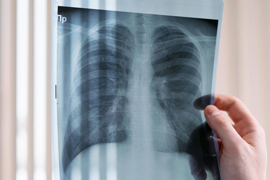 Imagem de pulmão de paciente com DPOC (Doença Pulmonar Obstrutiva Crônica), doença que teve medicamento de alto custo incorporado no rol dos planos de saúde - Pexels