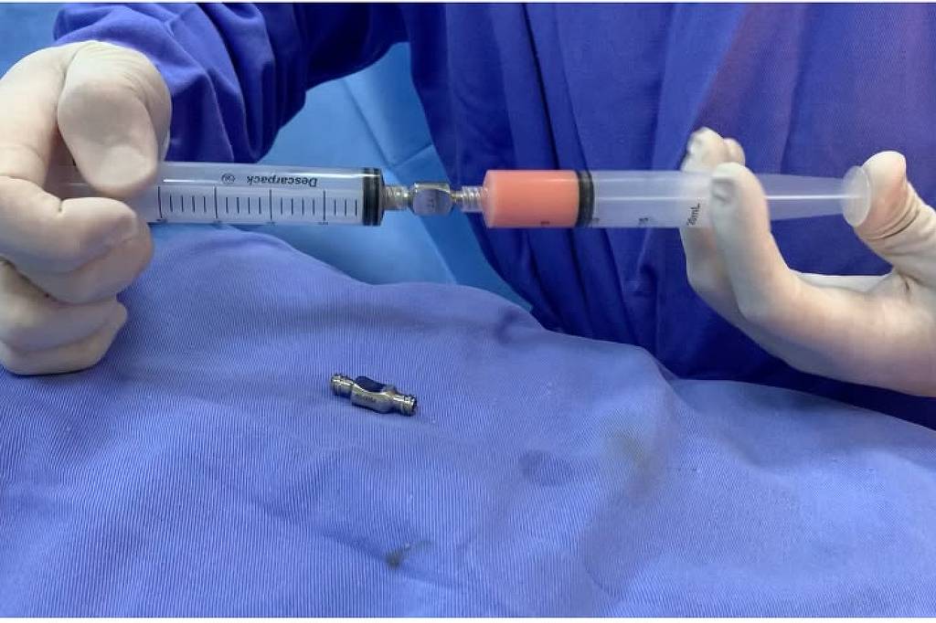 Nanofat: a técnica de enxerto de gordura que promete rejuvenescimento divide opiniões médicas