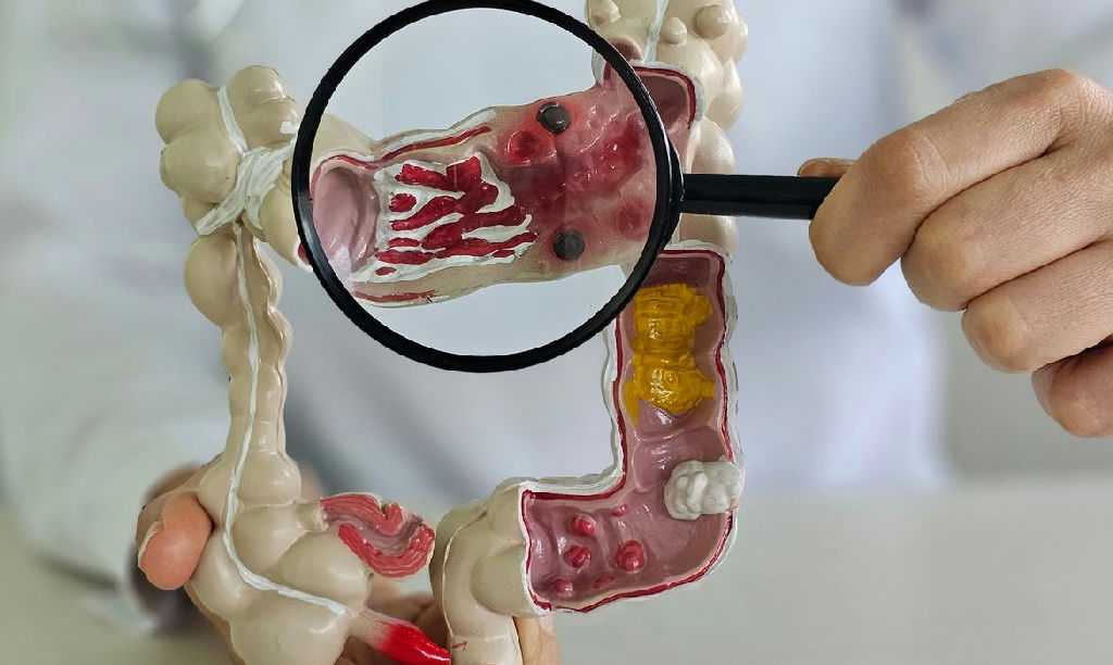 Doença inflamatória intestinal dispara cinco vezes no Brasil em pouco mais de uma década