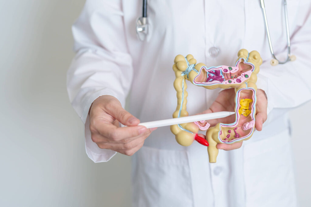 Estudo revela causas biológicas da agressividade do câncer de intestino em jovens
