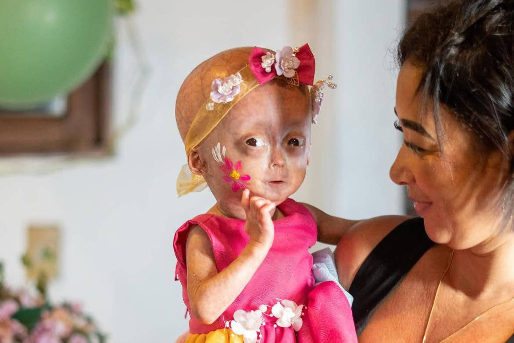 Morre Elis, menina que lutava contra síndrome rara de envelhecimento precoce