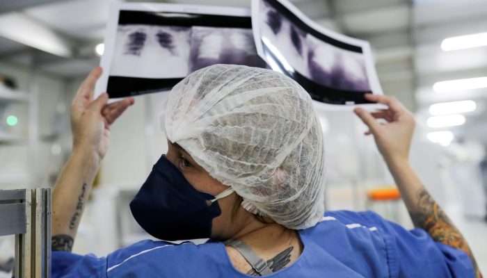 Detecção precoce é essencial para aumentar sobrevida de pacientes com câncer de pulmão no SUS