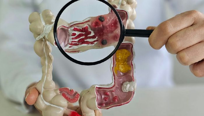 Doença inflamatória intestinal dispara cinco vezes no Brasil em pouco mais de uma década