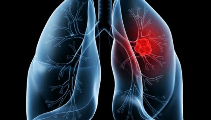 Entenda o adenocarcinoma pulmonar, o câncer diagnosticado no Papa Leão