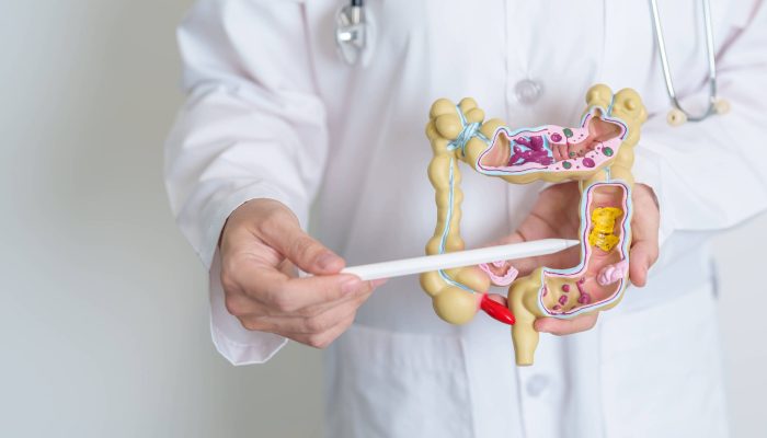 Estudo revela causas biológicas da agressividade do câncer de intestino em jovens