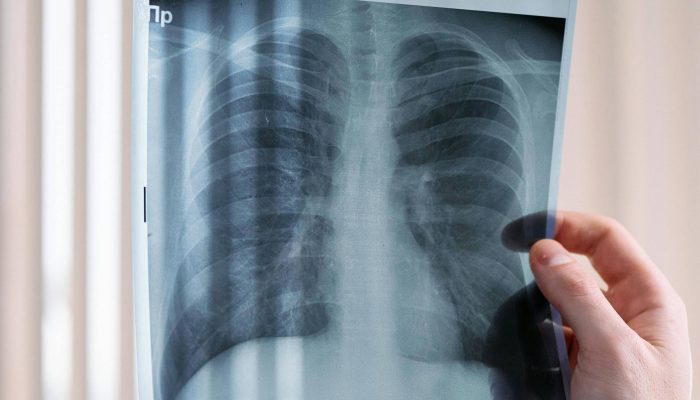 Imagem de pulmão de paciente com DPOC (Doença Pulmonar Obstrutiva Crônica), doença que teve medicamento de alto custo incorporado no rol dos planos de saúde - Pexels