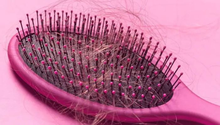 Escova com fios de cabelo indicando queda capilar; equipe de pesquisadores afirma ter conseguido recriar, em camundongos, o ciclo completo de crescimento do cabelo - Getty Images
