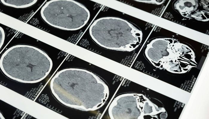 Anvisa amplia acesso a tratamentos pediátricos para lúpus e esclerose múltipla