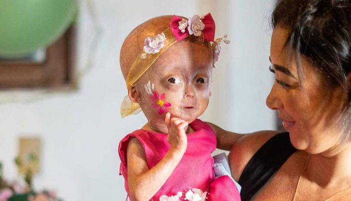 Morre Elis, menina que lutava contra síndrome rara de envelhecimento precoce
