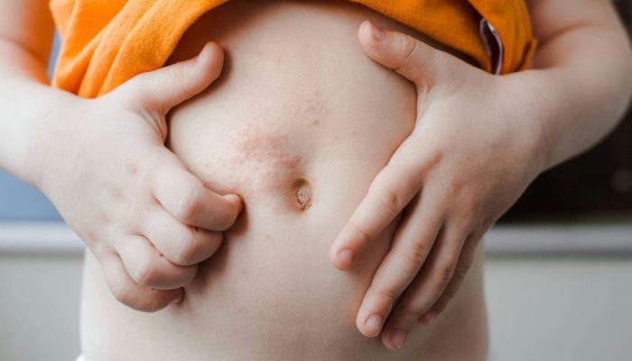 Surtos de sarna humana atingem 16 crianças em escolas de Andradas